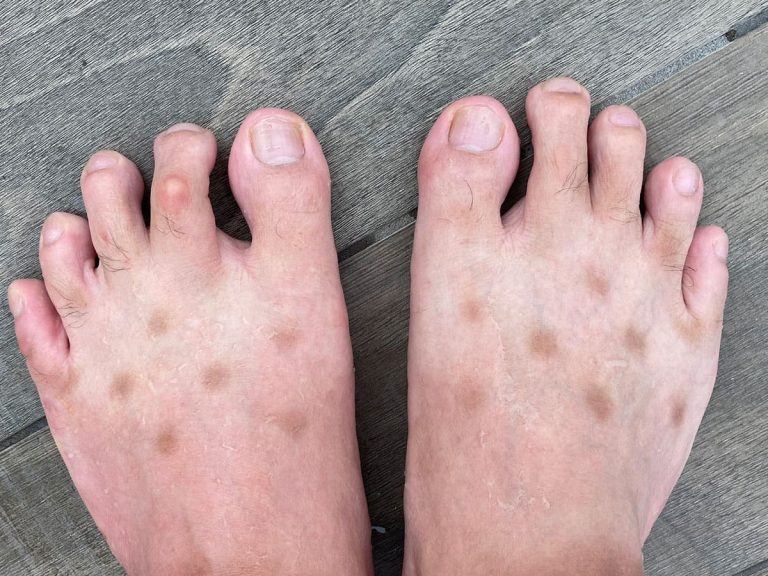 Strange Foot Disease Has a Simple Diagnosis